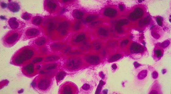 Cum funcționează celula care ucide toate tipurile de cancer și de ce este diferită de tot ce s-a descoperit până acum