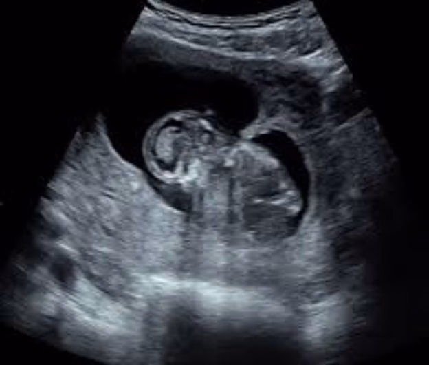 Primul tratament intrauterin pentru o boală genetică