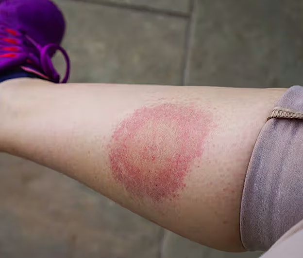 Un nou orizont în lupta împotriva bolii Lyme: un antibiotic din clasa penicilinelor promite tratamente mai sigure și mai eficiente