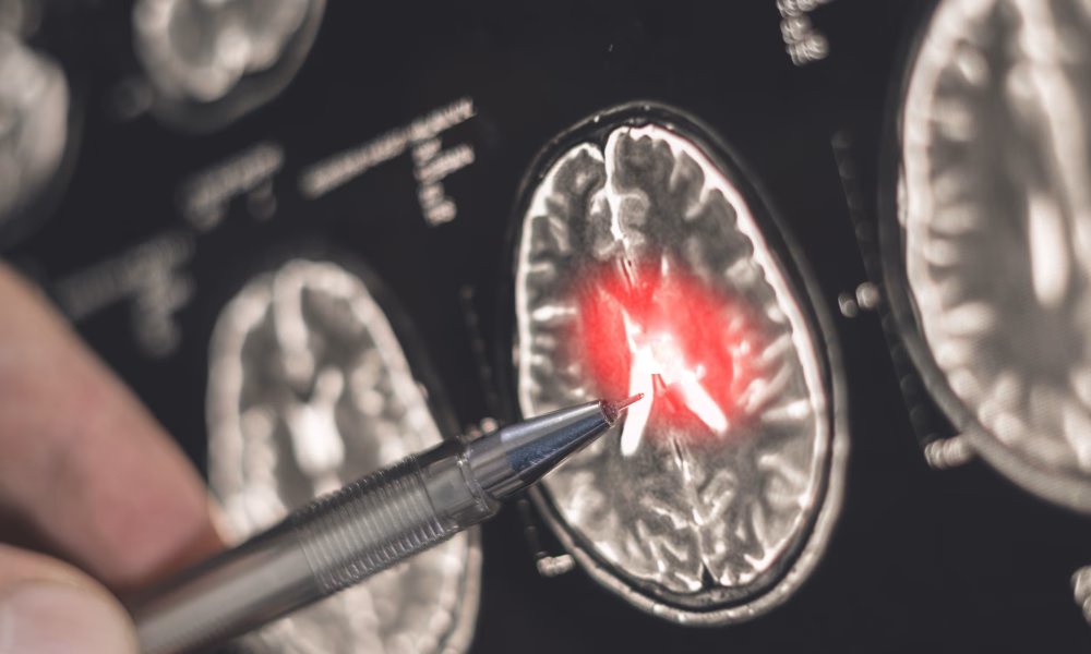 Alzheimer, diagnosticare timpurie, Institutul Politehnic Worcester, inteligența artificială, pierdere volum cerebral