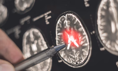 Alzheimer, diagnosticare timpurie, Institutul Politehnic Worcester, inteligența artificială, pierdere volum cerebral