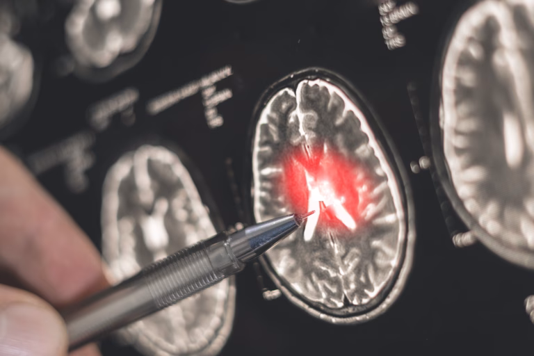 Pas important în diagnosticarea Alzheimer: un instrument cu 93% precizie